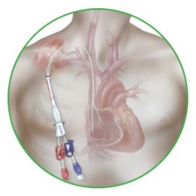 Cewniki dwukanałowe do dializ Teleflex Arrow Cannon II Plus