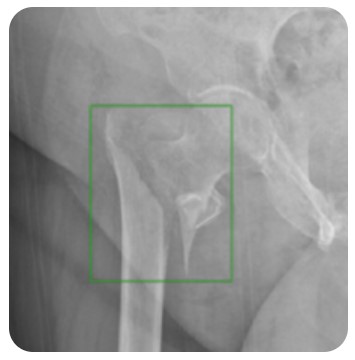 Diagnostyka obrazowa - oprogramowanie Carebot AI BONES