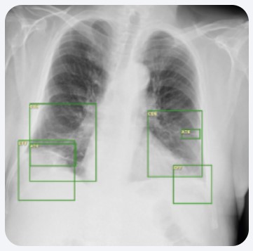 Diagnostyka obrazowa - oprogramowanie Carebot AI CXR
