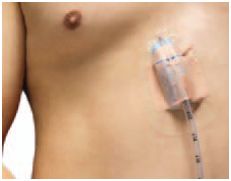 Opatrunki mocujące (cewnik, dren, kaniula) Copenhagen Medlab Pluera-Guard