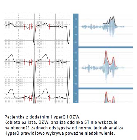 Oprogramowanie do Aparatów EKG HyperQ Spoczynkowe