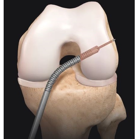 Rozwiertaki do artroskopii ARTHREX Flexible Reamers
