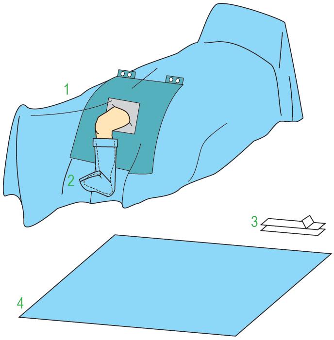 Zestawy do ortopedii – obłożenia pola operacyjnego JKT/MOLNLYCKE Zestaw do artroskopii IV 380139