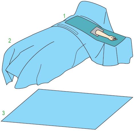 Zestawy do ortopedii – obłożenia pola operacyjnego JKT/MOLNLYCKE Zestaw do operacji na kończynie górnej II 380185