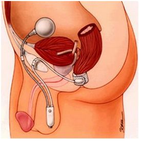 Zwieracze odbytu AMS Action Neoshincter