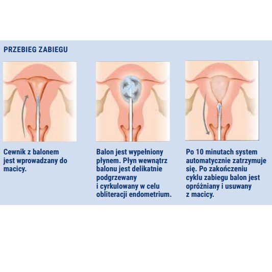 Leczenie dysfunkcjonalnego krwawienia z macicy 