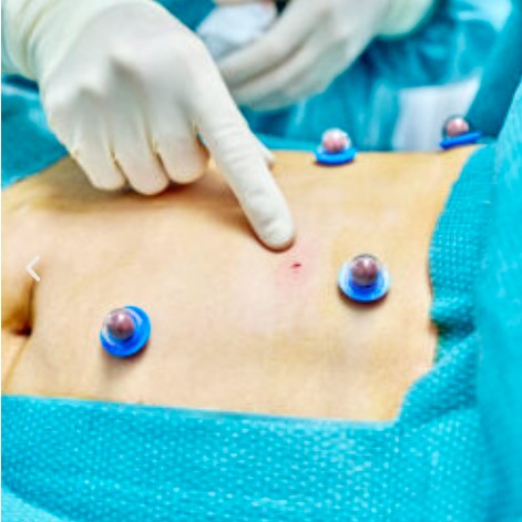  Aparaty do ablacji guzów Cascination CAS-One IR