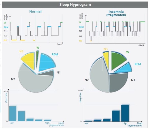 Aparaty do diagnostyki bezdechu sennego - polisomnografy SOMNOmedics HST