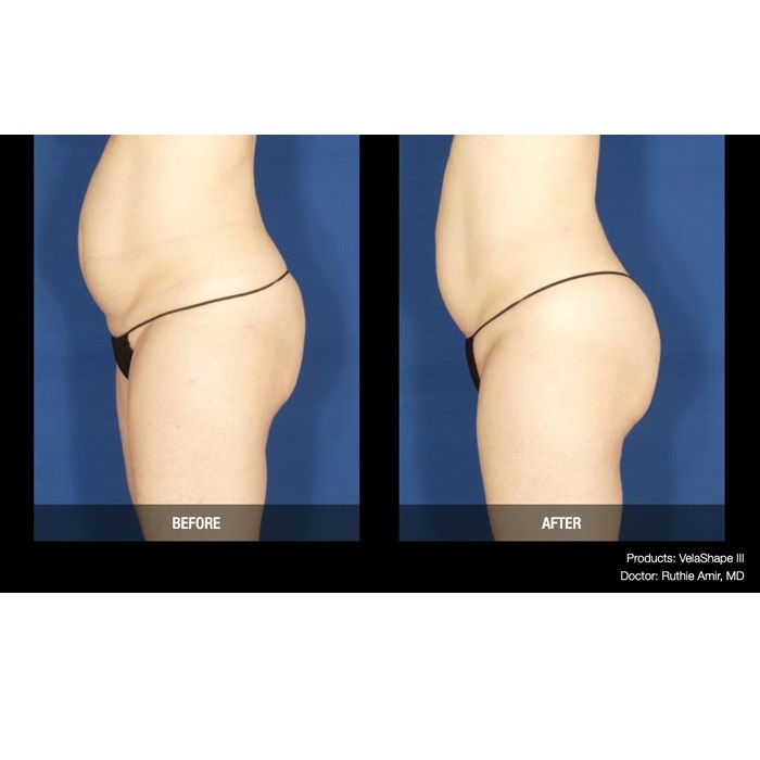 Aparaty do kosmetologii – Combo Candela VelaShape III