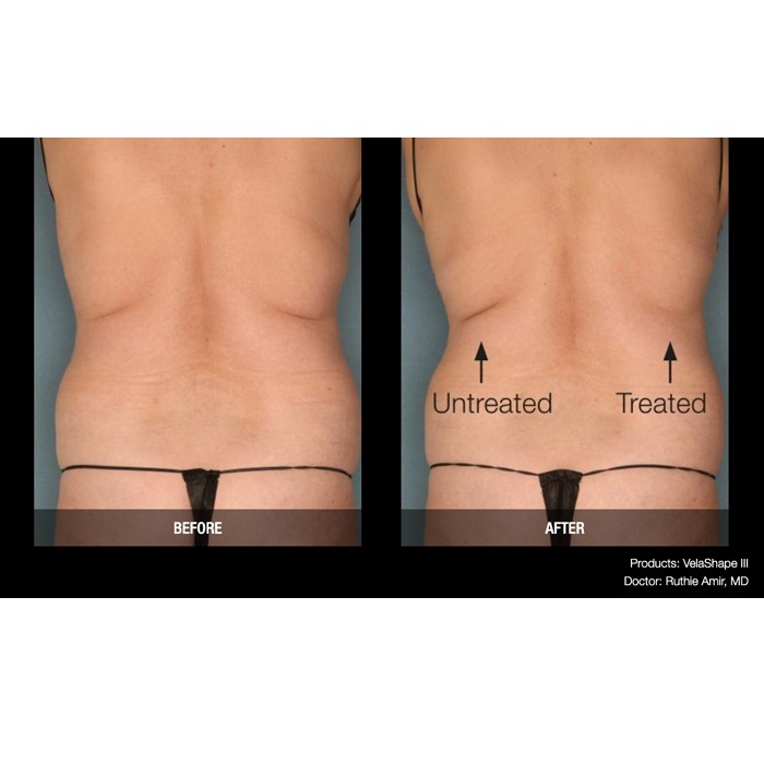 Aparaty do kosmetologii – Combo Candela VelaShape III