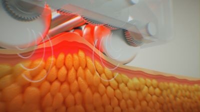 Aparaty do kosmetologii – Combo LestheZone LipoRadioLogie™ VINCI