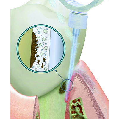 Aparaty do leczenia przyzębia Durr Dental Vector