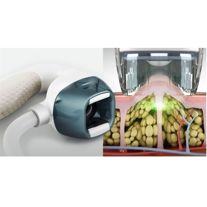 Aparaty do redukcji cellulitu i modelowania sylwetki Candela VelaShape III