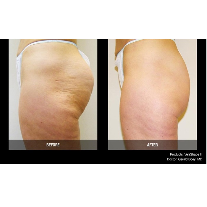 Aparaty do redukcji cellulitu i modelowania sylwetki Candela VelaShape III