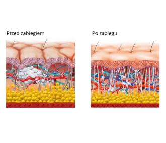 Aparaty do terapii falami uderzeniowymi B/D Fala uderzeniowa elektromagnetyczna