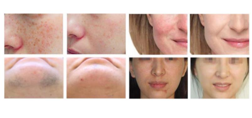 Aparaty IPL i VPL B/D IPL E-Light