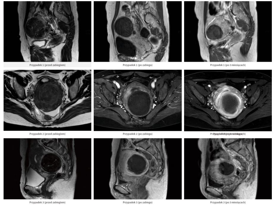 Aparaty ultradźwiękowe do leczenia mięśniaków macicy HIFU Alpinion Alpius 900