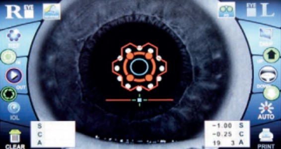 Autorefraktometry (autokeratorefraktometry) G2 OPTIC SINGLE LTL