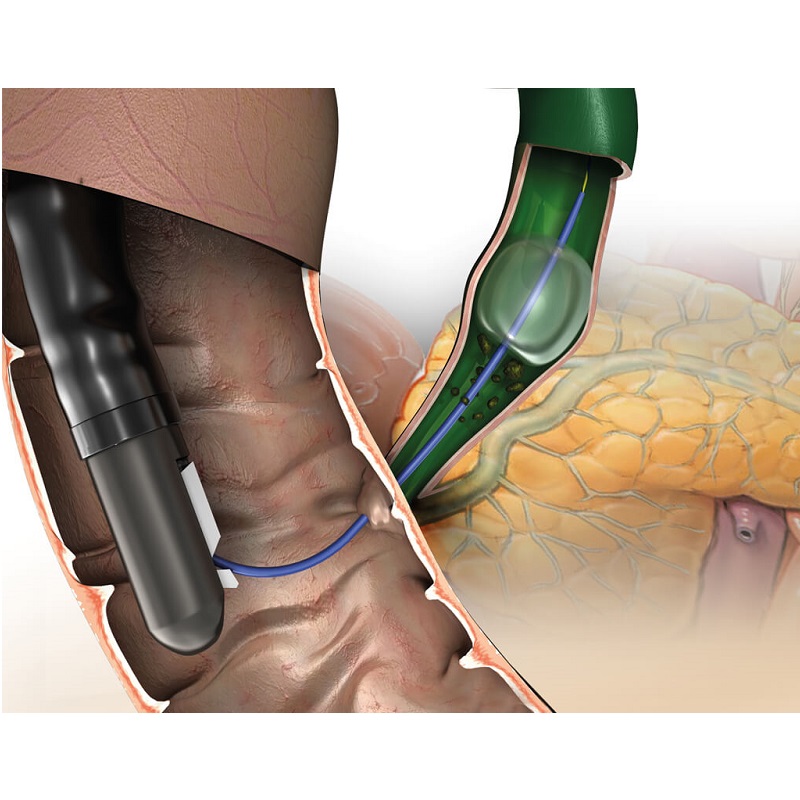 Balony do kamieni do endoskopów giętkich MICRO-TECH SWEEPER STONE