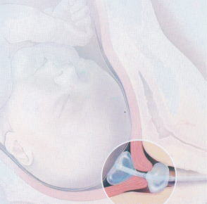 Balony do poszerzania szyjki macicy  B/D do poszerzania szyjki macicy 