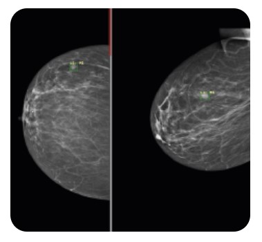 Diagnostyka obrazowa - oprogramowanie Carebot AI MMG