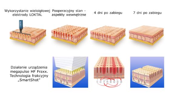 Diatermie chirurgiczne - Aparaty elektrochirurgiczne Loktal Megapuls HF Fraxx