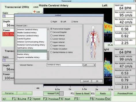 Dopplery naczyń czaszkowych i szyjnych Atys Medical WAKIe TCD
