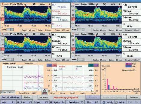 Dopplery naczyń czaszkowych i szyjnych Atys Medical WAKIe TCD