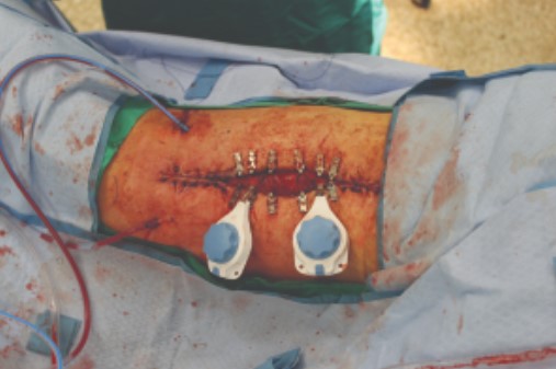 Ekspandery tkankowe do zamykania ran DermaClose DermaClose