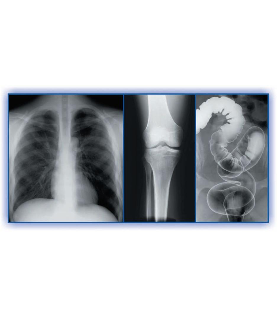 Filmy RTG – ogólnodiagnostyczne Carestream MXB 152 2200