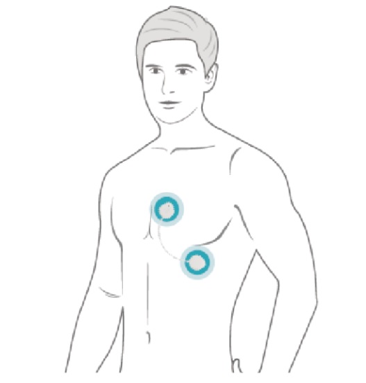 Holtery EKG – rejestratory Wellysis S-Patch EX