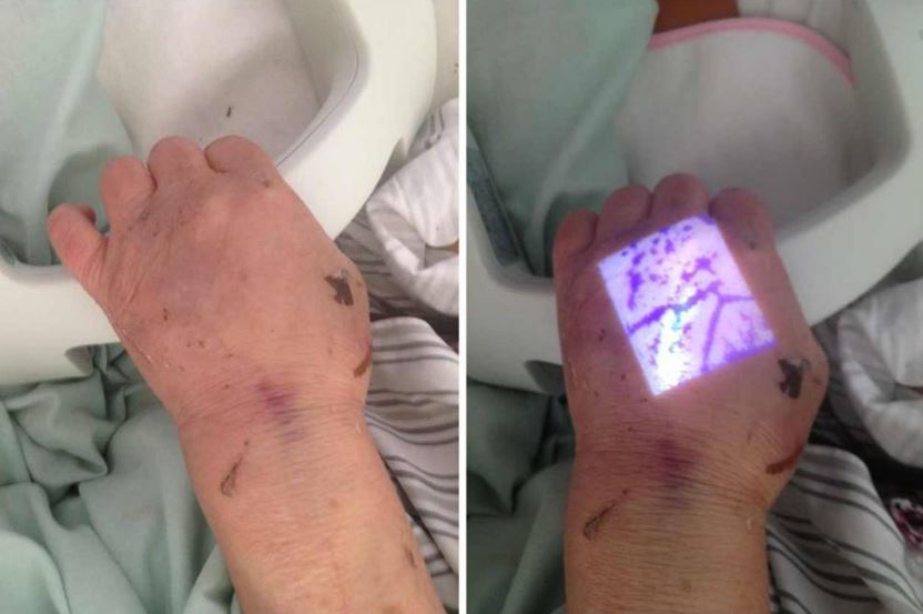 Iluminatory naczyniowe (skanery żył) ZD - Medical Inc. JM-260-01