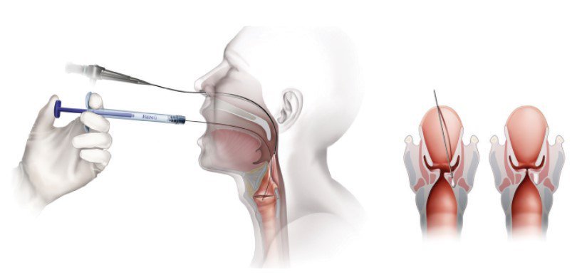 Implanty iniekcyjne laryngologiczne Soluvos Medical Renu Voice