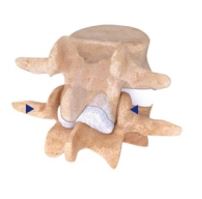 Implanty międzyłukowe kręgosłupa Cousin Surgery INTRASPINE