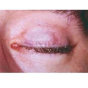 Implanty powiek SPIGGLE & THEIS implanty