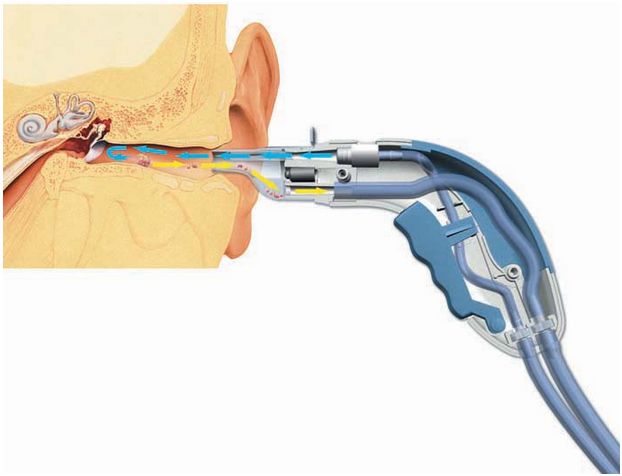Irygatory laryngologiczne Welch Allyn Ear Wash