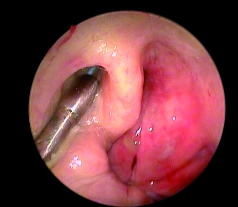 Katetery uszne SPIGGLE & THEIS TubaVent