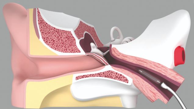 Katetery uszne SPIGGLE & THEIS TubaVent