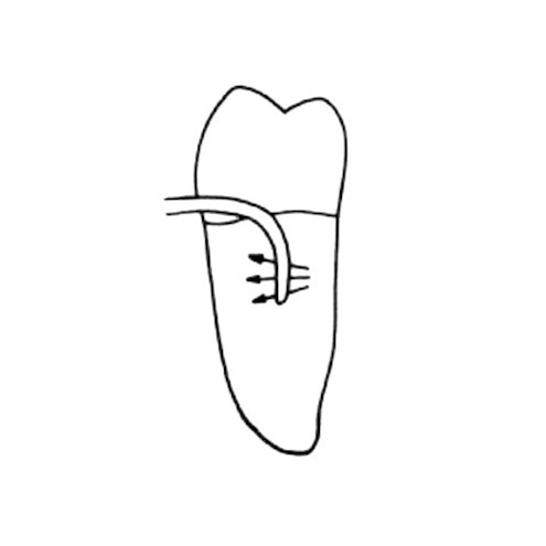 Kirety stomatologiczne (usuwanie kamienia nazębnego) LM-Instruments SV