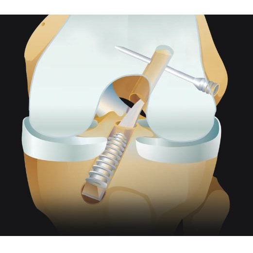 Łączniki tkanek miękkich do artroskopii ARTHREX BioComposite TransFix