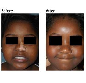 Lampy do fototerapii UV PhotoMedex VTRAC