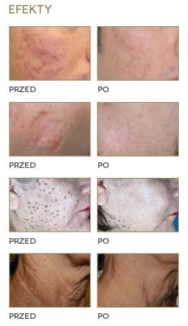 Lasery chirurgiczne DEKA Golden Touch