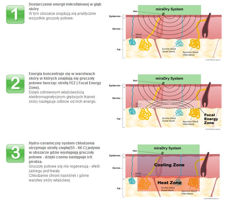 Lasery chirurgiczne miraDry System miraDry