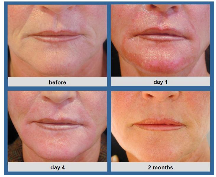 Lasery dermatologiczne Alma Lasers BURANE i BURANE XL