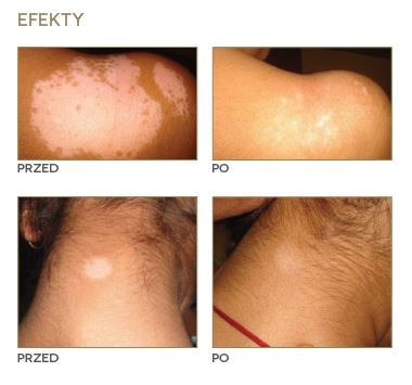 Lasery dermatologiczne Alma Lasers Excimer