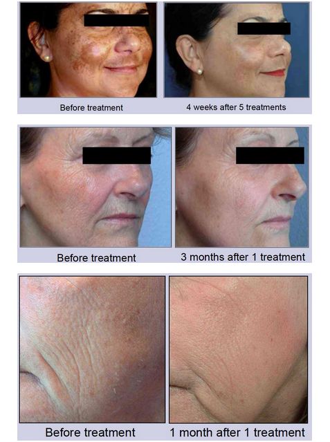 Lasery dermatologiczne Alma Lasers EXELO2