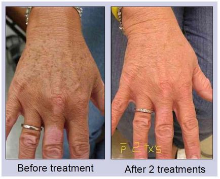 Lasery dermatologiczne Alma Lasers SINON