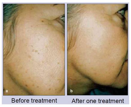 Lasery dermatologiczne Alma Lasers SINON