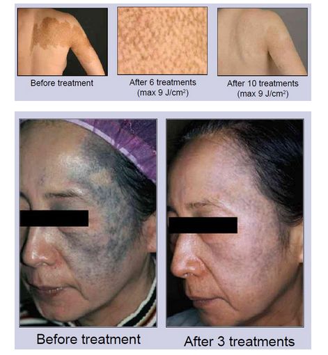 Lasery dermatologiczne Alma Lasers SINON