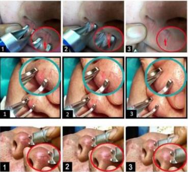 Lasery dermatologiczne B/D Vascular Laser
